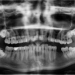 x ray, zähne, zahn fehlt