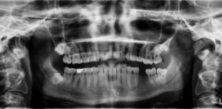 x ray, zähne, zahn fehlt