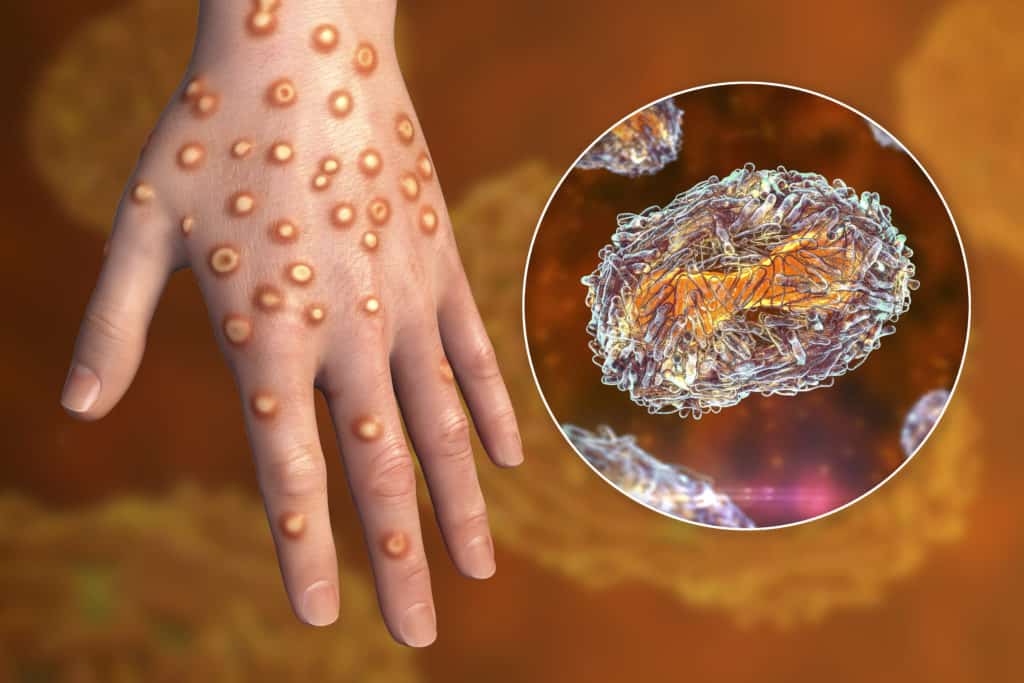 Zoonosene:Hand of a patient with monkeypox infection, 3D illustration. Monkeypox is a zoonotic virus from Poxviridae family, causes monkeypox, a pox-like disease
