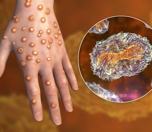 Zoonosene:Hand of a patient with monkeypox infection, 3D illustration. Monkeypox is a zoonotic virus from Poxviridae family, causes monkeypox, a pox-like disease