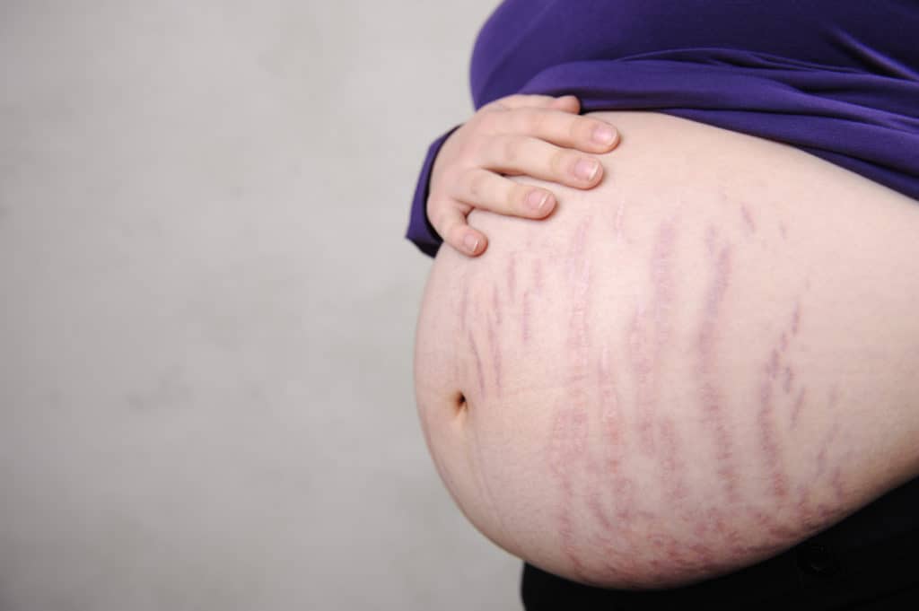 Schwangerschaftsstreifen-vorbeugen-Begleiterscheinungen-Deiner-Schwangerschaft