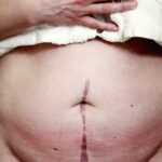 Photo surgical scar