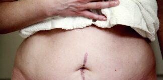 Photo surgical scar