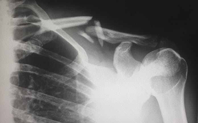 Photo Shoulder pain