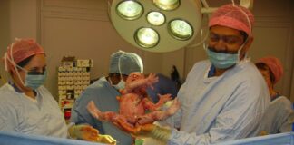 Photo "Breech position cesarean section"